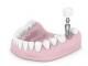 Riscuri si efecte negative in urma procedurii de implant dentar