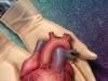 Pacientii romani vor putea beneficia in curand de transplant de organe de la donatori europeni