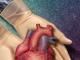 Informatii esentiale despre transplantul de organe 