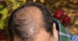 Transplantul de par (graftingul) si reducerea scalpului