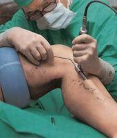 Anestezie în timpul funcționării în varicoză, Ce anestezie pentru chirurgia varicelor