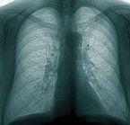 Tuberculoza – in continuare o problema majora de sanatate publica 