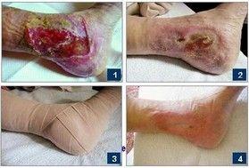 încarcarea picioarelor în picioarele varicoase tratamentul venelor varicoase în medicina populara