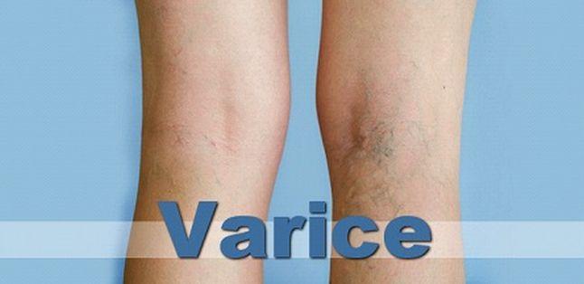 Psihosomatica: de ce vene varicoase apar pe picioare - Articole Duul circular în varicoza