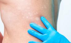 Se poate preveni vitiligo?