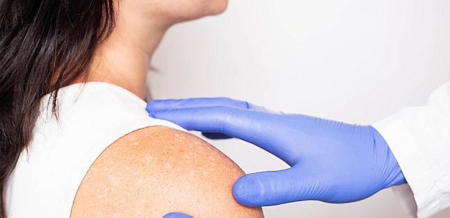 Vitiligo: simptome, diagnostic, factori de risc, complicatii, tratament